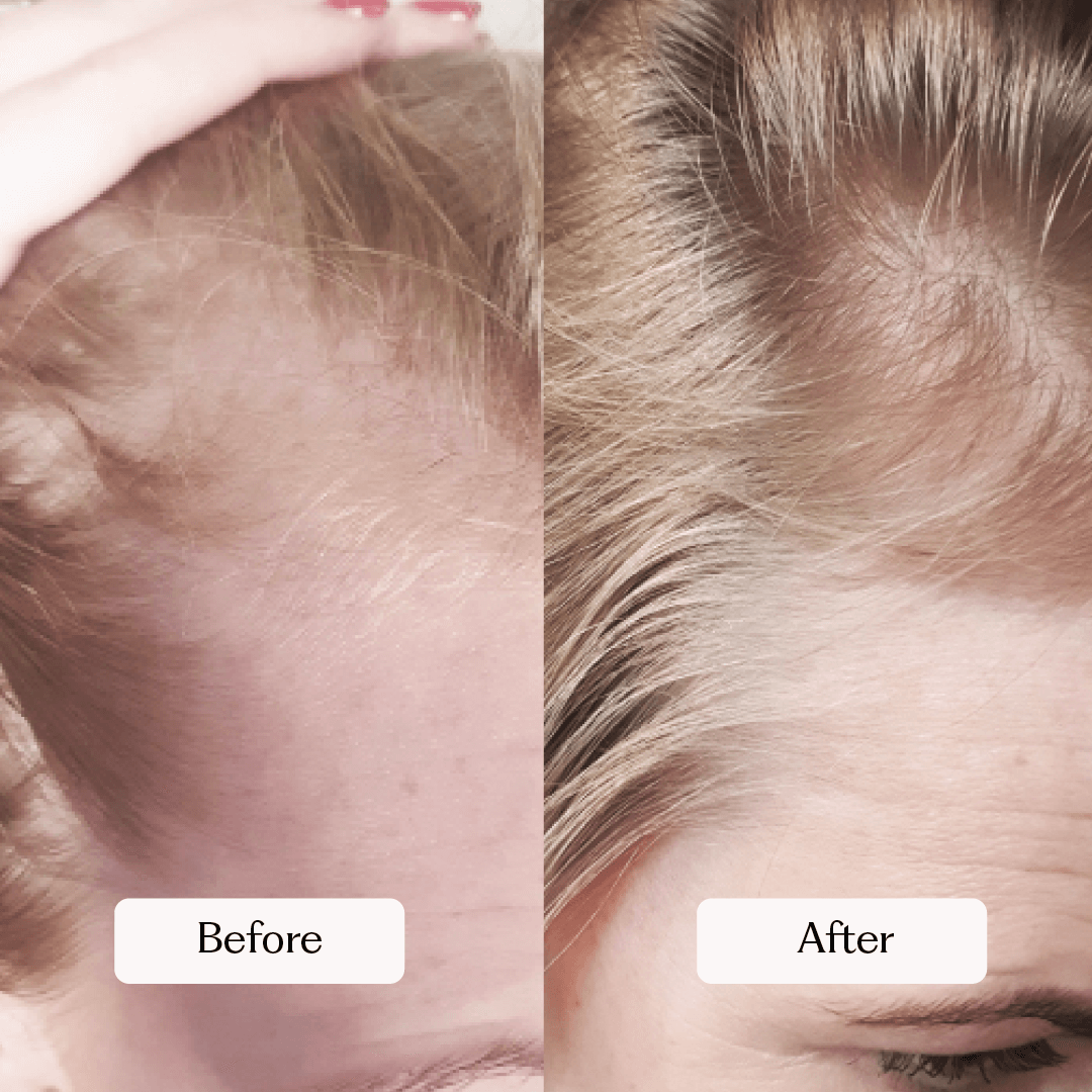 Hair Growth Kit